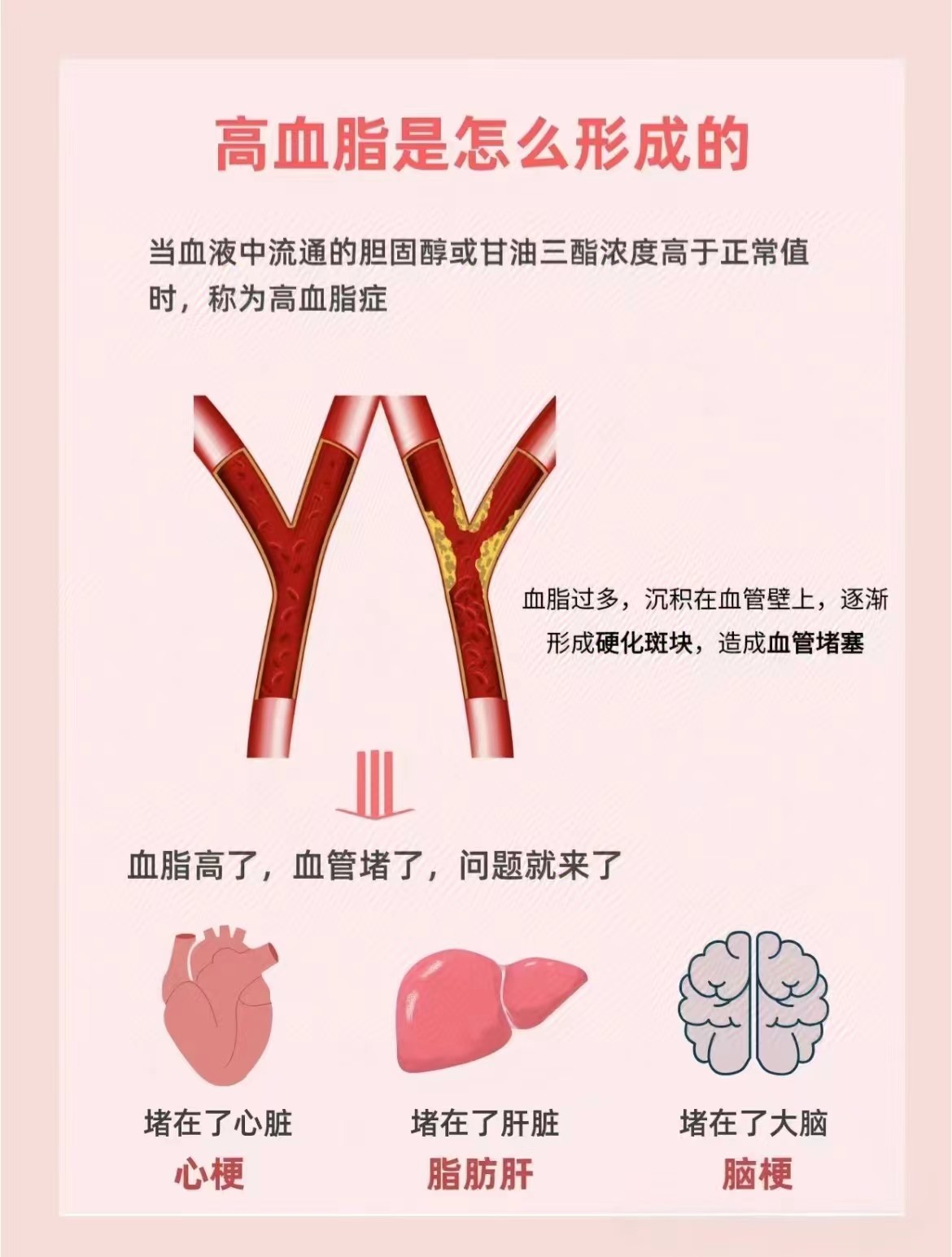 高血脂到底是怎么形成的